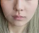 ボトックス（エラ・小顔） AYANAフィラーズクリニック 渋谷院 AFTER サムネイル用