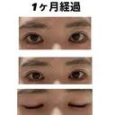 自然癒着法 / 眼瞼下垂（非切開） LUHO（ルホ）美容外科 DAY 31 サムネイル用