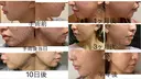 糸リフト / 脂肪吸引（顔） / ジョールファット除去 EMMO FACE CLINIC 東京三田院 AFTER サムネイル用