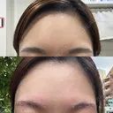 アートメイク除去・修正 しのぶ皮膚科 AFTER サムネイル用