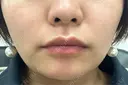 ボトックス（エラ・小顔） / ハイフ（顔） 湘南美容クリニック 大阪心斎橋院 AFTER サムネイル用