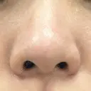 鼻尖形成（非切開） クリニーク大阪心斎橋 DAY 79 サムネイル用
