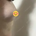 豊胸（脂肪注入） Mods Clinic（モッズクリニック） 大阪院 DAY 32 サムネイル用