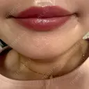アートメイク（唇） MKクリニック大阪院 DAY 18 サムネイル用
