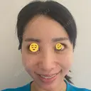 クマ治療 / 脂肪注入（目の下） 藤・ナチュレ美容クリニック 銀座院 DAY 37 サムネイル用