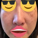 プラセンタ注射 / シミ取りレーザー 仁愛クリニック DAY 39 サムネイル用