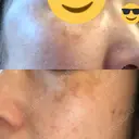 プラセンタ注射 / シミ取りレーザー 仁愛クリニック DAY 39 サムネイル用