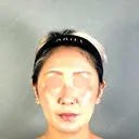 糸リフト / 脂肪吸引（顔） / ジョールファット除去 アリエル美容クリニック 郡山院 AFTER サムネイル用