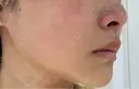 美肌レーザー / 美白レーザー / YAGレーザー / レーザーフェイシャル / 赤み除去レーザー AI Beauty Clinic （エーアイ美容クリニック） AFTER サムネイル用