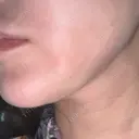 糸リフト / ボトックス（あご） / ヒアルロン酸注入（あご） / RF（高周波）たるみ治療 / ピーリング（ハリ・ツヤ） ルラ美容クリニック 千葉院 / ルラスキンクリニック 千葉院 DAY 3 サムネイル用