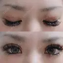 二重埋没 かめい美容クリニック宇都宮 AFTER サムネイル用