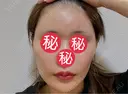 額を丸く / 脂肪注入（肌） / 脂肪注入（額） 湘南美容クリニック 柏院 AFTER サムネイル用
