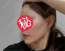額を丸く / 脂肪注入（肌） / 脂肪注入（額） 湘南美容クリニック 柏院 DAY 90 サムネイル用
