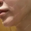 糸リフト / ボトックス（あご） / ヒアルロン酸注入（あご） / RF（高周波）たるみ治療 / ピーリング（ハリ・ツヤ） ルラ美容クリニック 千葉院 / ルラスキンクリニック 千葉院 DAY 4 サムネイル用