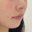 鼻尖形成（切開） / 鼻中隔延長（切開） / 軟骨移植 / 鼻孔縁下降 LIVIN CLINIC DAY 13 サムネイル用