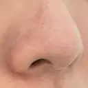鼻尖形成（非切開） クリニーク大阪心斎橋 DAY 82 サムネイル用