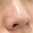 鼻尖形成（非切開） クリニーク大阪心斎橋 DAY 81 サムネイル用