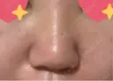 隆鼻術 / 鼻尖縮小 サラ美容外科 DAY 2 サムネイル用