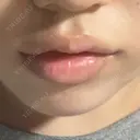 ヒアルロン酸注入（涙袋） / ヒアルロン酸注入（唇） / ボトックス（口角） フィラークリニック 大阪梅田院 DAY 0 サムネイル用