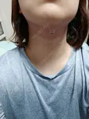 糸リフト / 脂肪吸引注射（顔） EMMO FACE CLINIC 大阪梅田院 DAY 1 サムネイル用