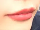 ヒアルロン酸注入（唇） Wi Clinic （ウィ クリニック）心斎橋院 DAY 4 サムネイル用