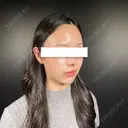 二重埋没 / 目頭切開 / 鼻尖形成（切開） / その他（鼻） / クマ治療 / 脂肪吸引（顔） / 軟骨移植 / 鼻孔縁挙上 R Beauty CLINIC 銀座院 DAY 35 サムネイル用