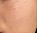 エレクトロポレーション / 光治療（フォトフェイシャルなど） 若倉診療所 DAY 1 サムネイル用