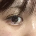 ヒアルロン酸注入（涙袋） / ヒアルロン酸注入（唇） / ボトックス（口角） フィラークリニック 大阪梅田院 DAY 2 サムネイル用