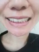 矯正（マウスピース） 銀座青山You矯正歯科 池袋西口医院 AFTER サムネイル用