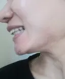 矯正（マウスピース） 銀座青山You矯正歯科 池袋西口医院 DAY 486 サムネイル用