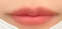 ヒアルロン酸注入（唇） Wi Clinic （ウィ クリニック）心斎橋院 AFTER サムネイル用