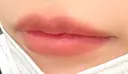 ヒアルロン酸注入（唇） Wi Clinic （ウィ クリニック）心斎橋院 DAY 6 サムネイル用