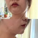 ハイフ（顔） 共立美容外科 広島院 AFTER サムネイル用