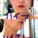 ハイフ（顔） 共立美容外科 広島院 DAY 1 サムネイル用