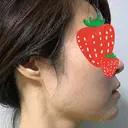 ボトックス（エラ・小顔） 湘南美容クリニック 京都院 DAY 0 サムネイル用
