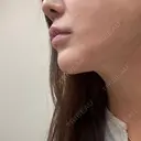 糸リフト / ボトックス（あご） / ヒアルロン酸注入（あご） / RF（高周波）たるみ治療 / ピーリング（ハリ・ツヤ） ルラ美容クリニック 千葉院 / ルラスキンクリニック 千葉院 DAY 8 サムネイル用