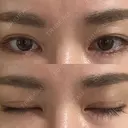 二重埋没 城本クリニック 福岡院 DAY 26 サムネイル用