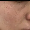 イオン導入 / ピーリング（ハリ・ツヤ） / ルメッカ ルラ美容クリニック 沖縄院 AFTER サムネイル用