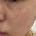 イオン導入 / ピーリング（ハリ・ツヤ） / ルメッカ ルラ美容クリニック 沖縄院 DAY 0 サムネイル用