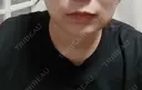 糸リフト / 脂肪吸引注射（顔） EMMO FACE CLINIC 大阪梅田院 DAY 3 サムネイル用
