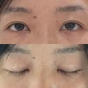 目頭切開 / 目尻切開 / 自然癒着法 LUHO（ルホ）美容外科 AFTER サムネイル用