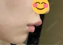 ヒアルロン酸注入（唇） ルラ美容クリニック 岐阜院 AFTER サムネイル用