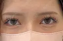 二重埋没 / 目頭切開 アリエル美容クリニック 大宮院 AFTER サムネイル用