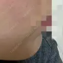 ボトックス（あご） 美容皮膚科エルムクリニック 岡山院 AFTER サムネイル用