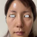 鼻尖形成（切開） / 小鼻縮小（切開） / その他（鼻） / 軟骨移植 eクリニック 福岡院 DAY 30 サムネイル用