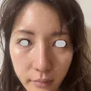 鼻尖形成（切開） / 小鼻縮小（切開） / その他（鼻） / 軟骨移植 eクリニック 福岡院 DAY 60 サムネイル用