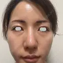 鼻尖形成（切開） / 小鼻縮小（切開） / その他（鼻） / 軟骨移植 eクリニック 福岡院 DAY 90 サムネイル用