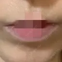 ボトックス（口角） 美容皮膚科エルムクリニック 岡山院 AFTER サムネイル用