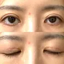 眼瞼下垂（切開） WOM CLINIC GINZA （ワム クリニック ギンザ） DAY 22 サムネイル用