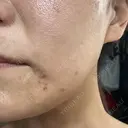 医療脱毛（ワキ） / ルメッカ ルラ美容クリニック 広島院 AFTER サムネイル用